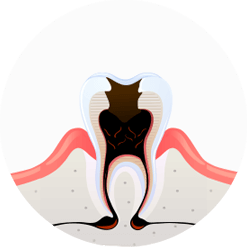 치아파절